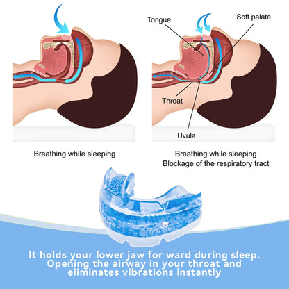Night Anti-Snoring Mouth Guard